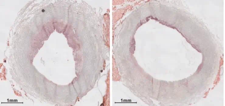 Imagen: De izq. a der.: Niveles de placa en una arteria antes y después de la infusión de nanoterapia (foto cortesía de la Universidad Estatal de Michigan)